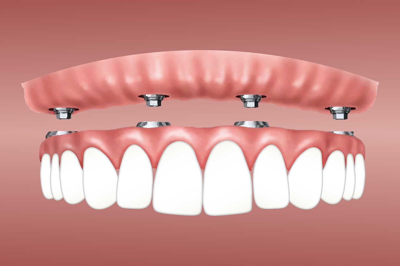 Leczenie ortodontyczne we Wrocławiu – aparat ortodontyczny